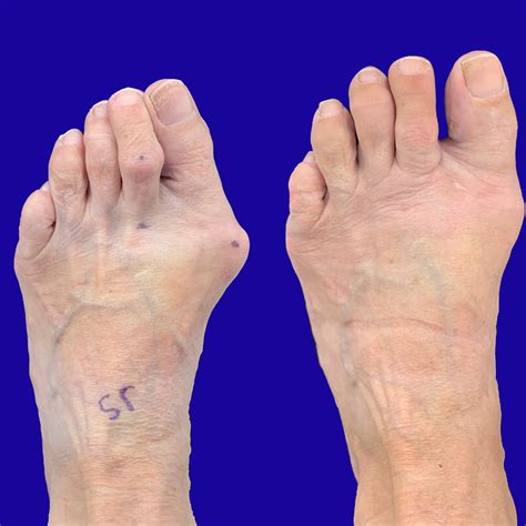 new bunion surgery